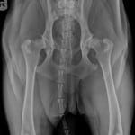 Bilateral Hip Osteoarthritis